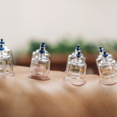 Hijama cupping treatment on women's back